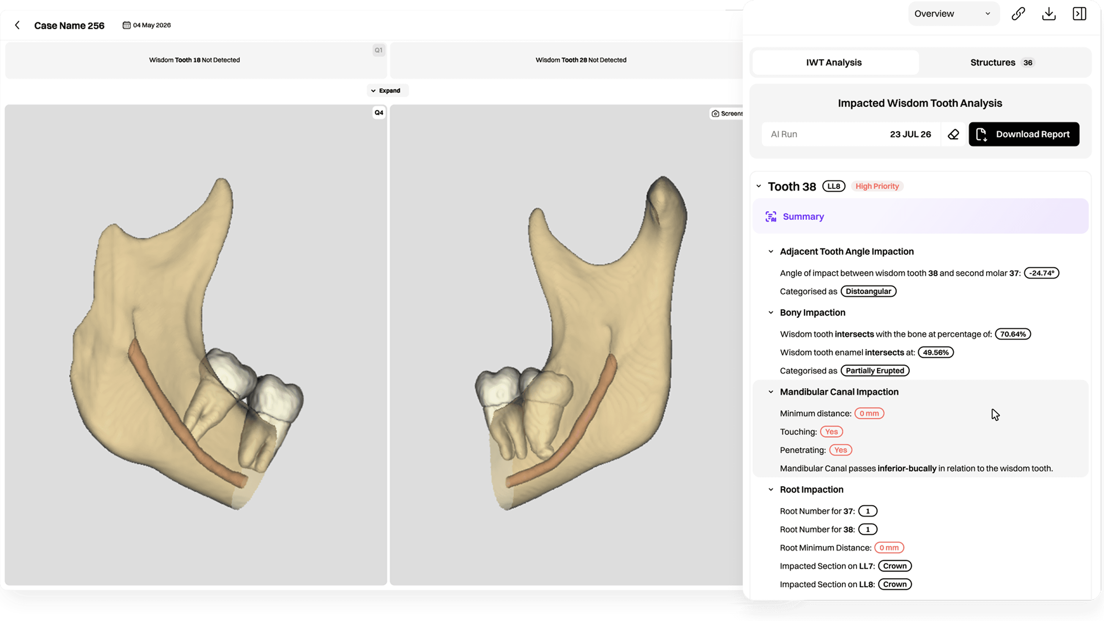 EAI Segment impacted wisdom tooth analysis report